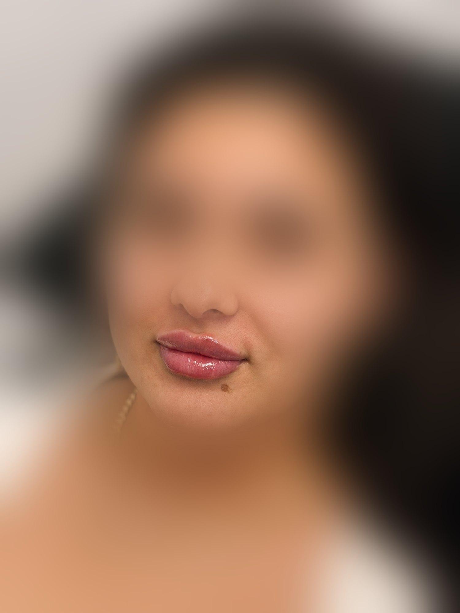 A natural, glossy lip-filler result at Empire aesthetics in Corby